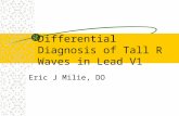 Differential Diagnosis of Tall R Waves in Lead V1 Eric J Milie, DO.