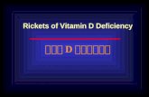 Rickets of Vitamin D Deficiency 维生素 D 缺乏性佝偻病. Definition Rickets is the term signifying a failure in mineralization of growing bone or osteoid tissue.