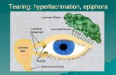 Tearing: hyperlacrimation, epiphora. Dry eye: tear break-up time, Schirmer test
