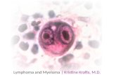 Lymphoma and Myeloma | Kristine Krafts, M.D.. Leukemia Malignancy of hematopoietic cells Starts in bone marrow, can spread to blood, nodes Myeloid or.