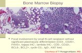 Bone Marrow Biopsy Focal involvement by small B-cell neoplasm without significant plasmacytic differentiation (CD3-, CD20+, PAX5+, kappa IHC-, lambda IHC-,