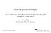 Teaching NeuroImages An 83-year-old woman with phonatory breaks and left hand rest tremor Neurology Resident and Fellow Section © 2013 American Academy.