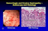 Hemorrhagic and Erosive Gastropathy - Endoscopy and Histology.