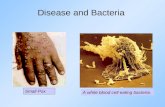 Disease and Bacteria A white blood cell eating bacteria. Small Pox.