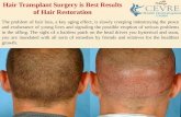 Hair Transplant Surgery is Best Results of Hair Restoration