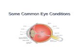 Some Common Eye Conditions