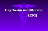 Erythema multiforme                   (EM)