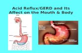 Acid Reflux/GERD and Its Affect on the Mouth & Body