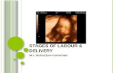 Stages of Labour & Delivery
