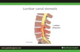 Lumbar  canal stenosis