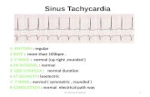 Sinus Tachycardia