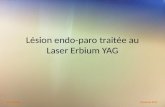 Lésion  endo-paro  traitée au Laser Erbium YAG