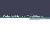Colecistitis Por Colelitiasis