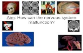 Aim: How can the nervous system malfunction?. Nervous System Malfunctions Polio Cerebral Palsy Meningitis Stroke Alzheimer's Disease.
