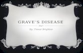 GRAVE’S DISEASE By: Trevor Brighton. QUICK OVERVIEW  Grave’s disease is a thyroid gland disorder which causes the accelerated production of the thyroid.