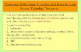 Diseases Affecting Tubules and Interstitium Acute Tubular Necrosis: It is a clinicopathological entity characterized morphologically by destruction of.