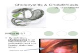16 cholecystitis