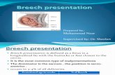 Breech Presentation-Muhammad Nzar