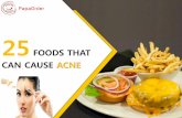 Acne problems? Avoid these Foods that can cause Acne