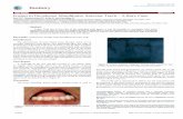 Fusion in Deciduous Mandibular Anterior Teeth – A Rare Case