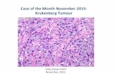 Case of the Month November 2015: Krukenberg Tumour
