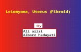 Leiomyoma, Uterus (Fibroid)