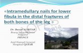 «Intramedullary nails for lower fibula in the distal fractures of both ...