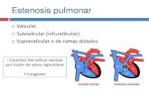 Estenosis pulmonares