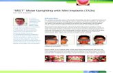 “MIST” Molar Uprighting with Mini Implants (TADs)