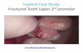 Implant Dentist Sydney Case study Video fractured 2nd premolar powerpoint pdf
