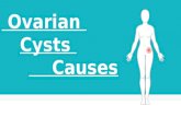 Ovarian Cyst Causes | Ovarian Cyst Treatment |Ovarian Cyst Pain