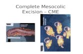 Complete mesocolic excision