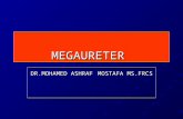 Adult megaureter