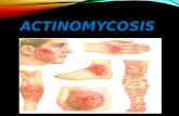 Actinomycosis  Information