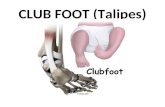 Club foot[1]