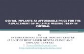 Dental implants at affordable price for the replacement of multiple missing teeth in chennai.