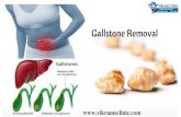 Gallstone Removal In Chennai | Gallstone Treatment In Tamilnadu