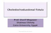 Choledochoduodenal fistulas