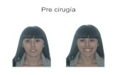 ortodoncia lingual y Cirugía ortognática bimaxilar