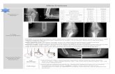 Elbow fractures -    Web viewEpi-demiology. Peak incidence 5-8yrs; most common paediatric elbow fracture; most common . fracture 95% FOOSH (flexion type,