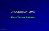CHOLESTEATOMA Pars Tensa Pattern - Queensland …Right pars tensa cholesteatoma. Keratin debris is evident in the postero-superior invagination. The lower drum has a...