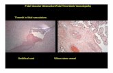 Fetal Vascular Obstruction/Fetal Thrombotic …pathology.uchicago.edu/sites/pathology.uchicago.edu/files/uploads...Fetal Vascular Obstruction/Fetal Thrombotic Vasculopathy . ... Fetal