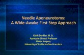 Needle Aponeurotomy: A Wide-Awake First Step … Aponeurotomy: A Wide-Awake First Step Approach Keith Denkler, M. D. Associate Clinical Professor Plastic Surgery University of California