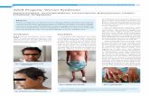 Adult Progeria: Werner Syndrome - Journal of Association ... · V 4 April 93 Adult Progeria: Werner Syndrome Nagappa Handargal1, Jananee Muralidharan2, P Praveen Sharma3, M Narayanswamy4,
