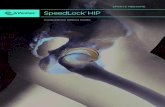 SpeedLock HIP - Creative Kong Selling Guide Manual vs. Incremental Tensioning SpeedLock HIP offers both manual tensioning and incremental tensioning (with ratchet wheels) options.