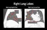 Right Lung Lobes - University of Wisconsin–Madisoncases.med.wisc.edu/anatomy/dissections/radiologyimages/...Right Lung Lobes Right Lung Sagittal View Right Lung Coronal View Minor
