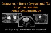 Images en « franc » hypersignal T2 du pelvis féminin Atlas ...pe.sfrnet.org/Data/ModuleConsultationPoster/pdf/2007/1/94caea6a-0c... · T1 FS Gadolinium I.b. Hématocolpos † Rétention