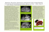 Massive abruptio placentae associated with coagulopathy ... · Massive abruptio placentae associated with coagulopathy mimicking thrombohaematoma (Breus mole) : ... Case presentation: