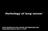 EASO COURSE ON LUNG CANCER AND … · • Congenial peribronchial ... • Neuroendocrine markers: – Chromogranin A ... • Mediastinum ,heart ,great vessels,trachea