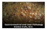 Gastrointes*nal and Liver Pathology · 10/15/2017 · Gastrointes*nal and Liver Pathology ... Transmural inflammation ULCERATIVE COLITIS Pseudopolyp Continuous colonic involvement,
